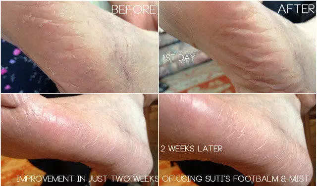 Before & After Suti Fab Foot Balm Review