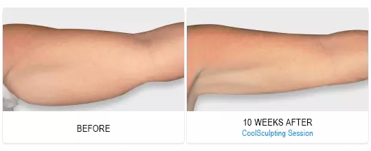 CoolSculpting