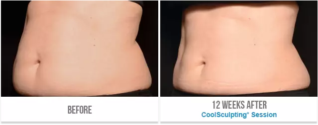 CoolSculpting